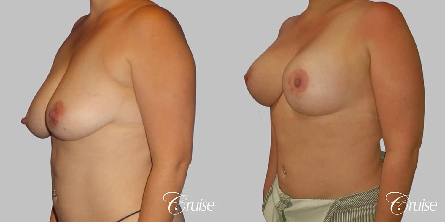Breast Lift Augmentation Before & After