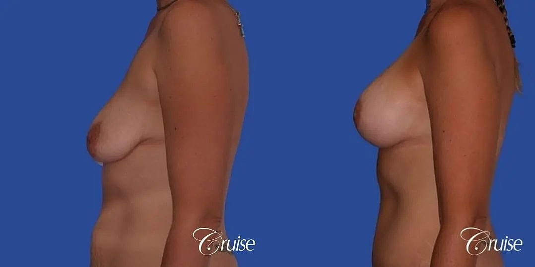 Breast Lift Augmentation Before & After