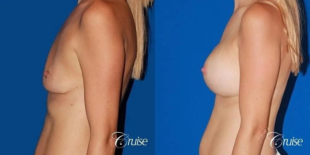 Breast Lift Augmentation Before & After