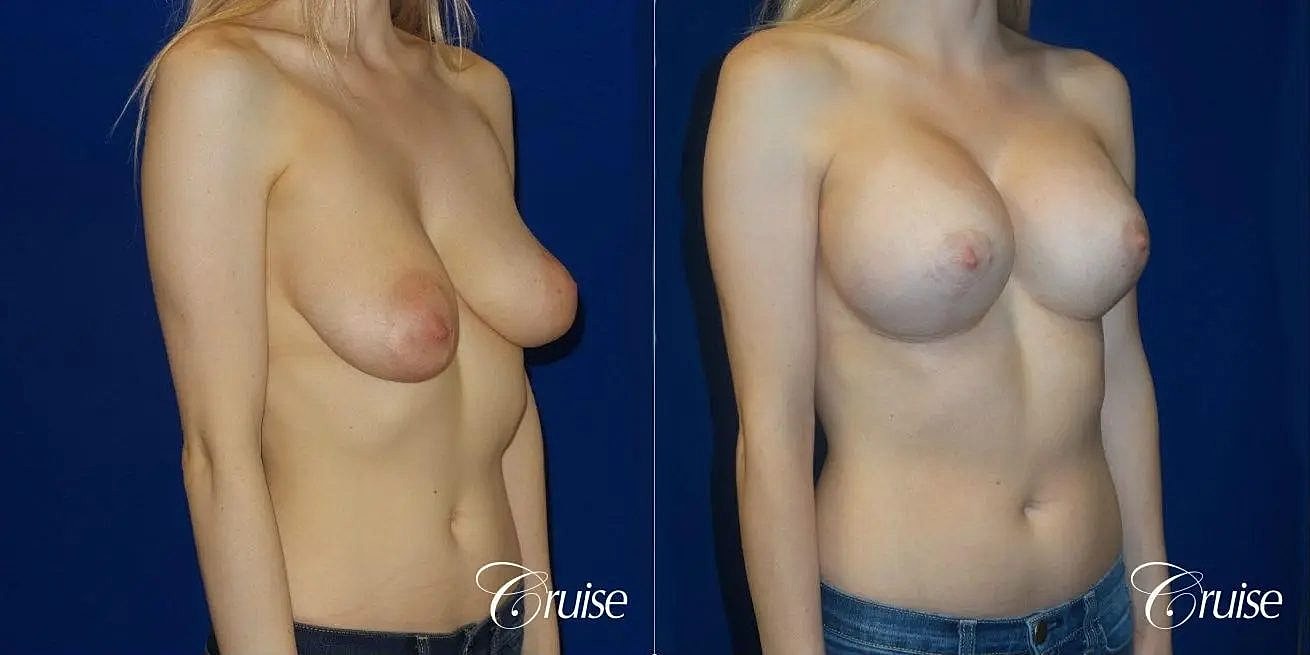 Breast Lift Augmentation Before & After