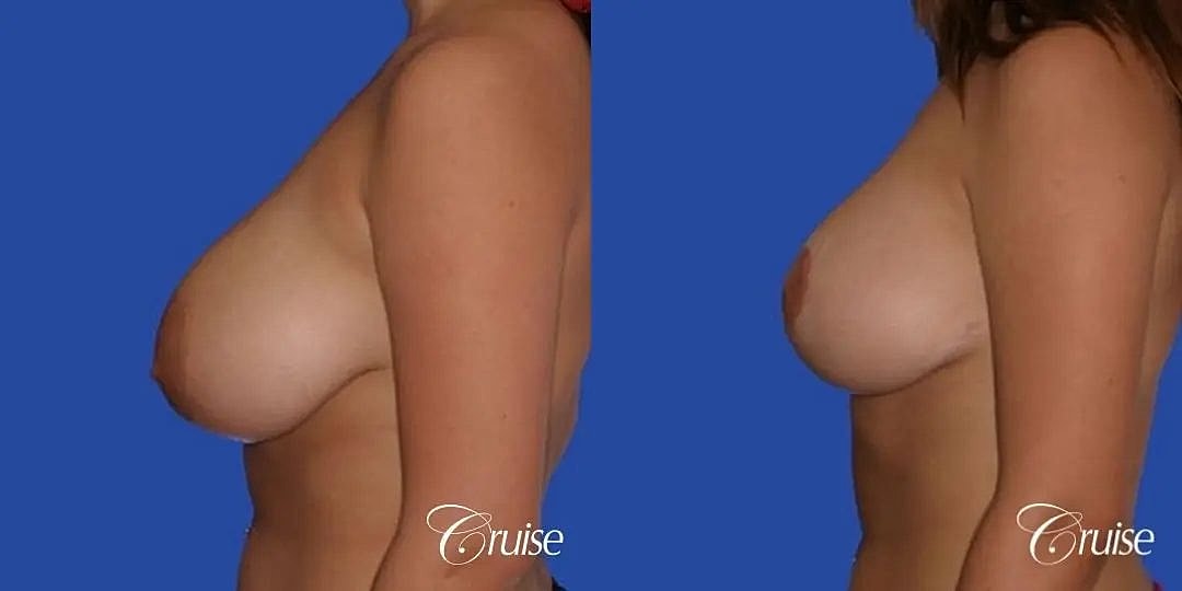 Breast Lift Augmentation Before & After