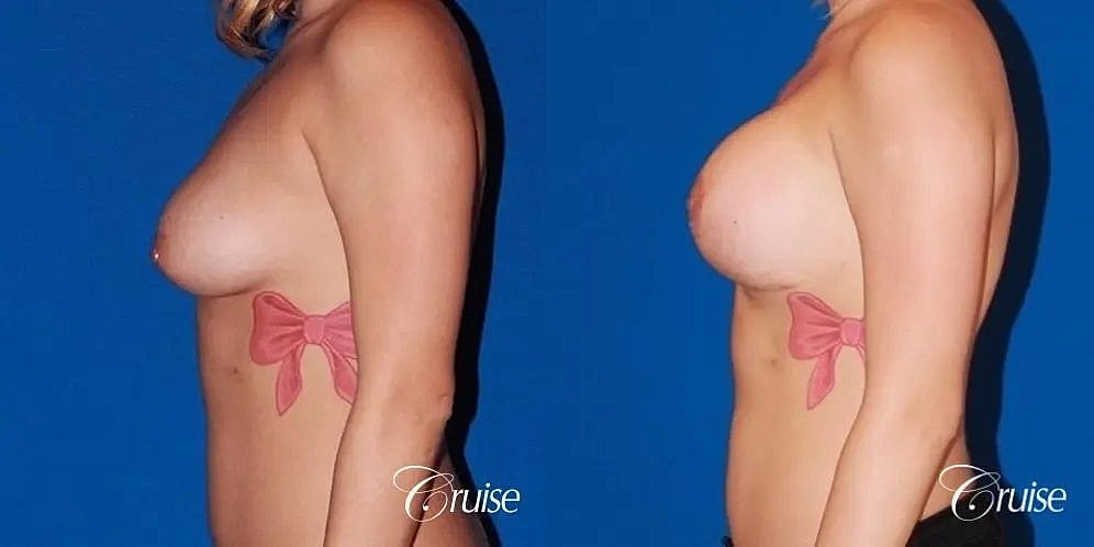 Breast Lift Augmentation Before & After