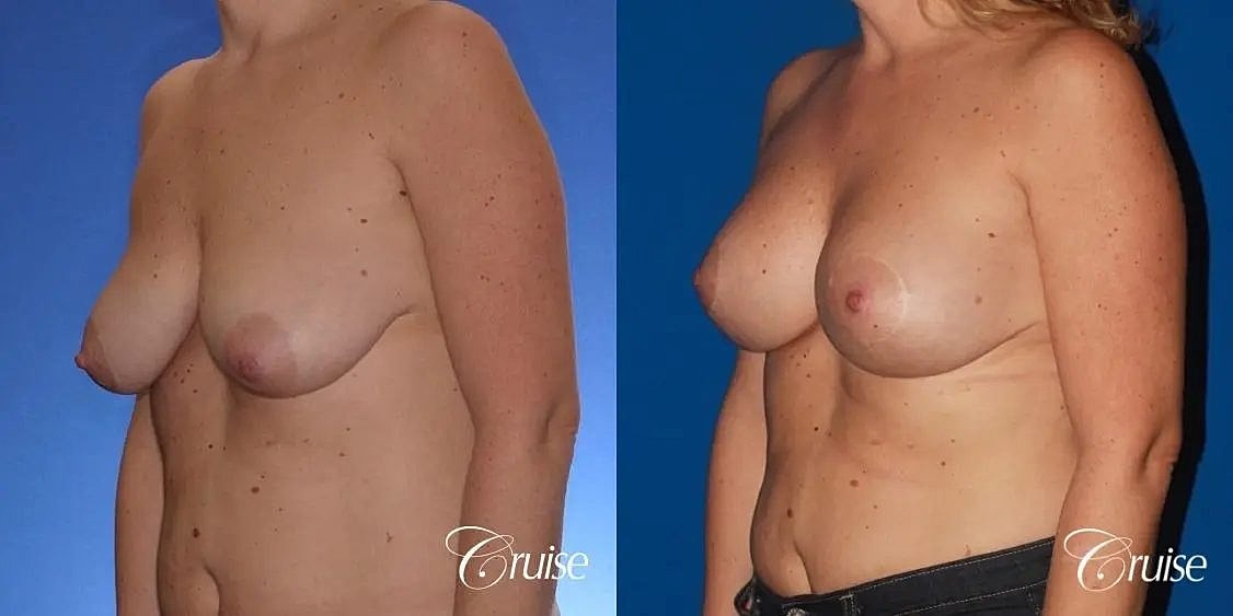 Breast Lift Augmentation Before & After