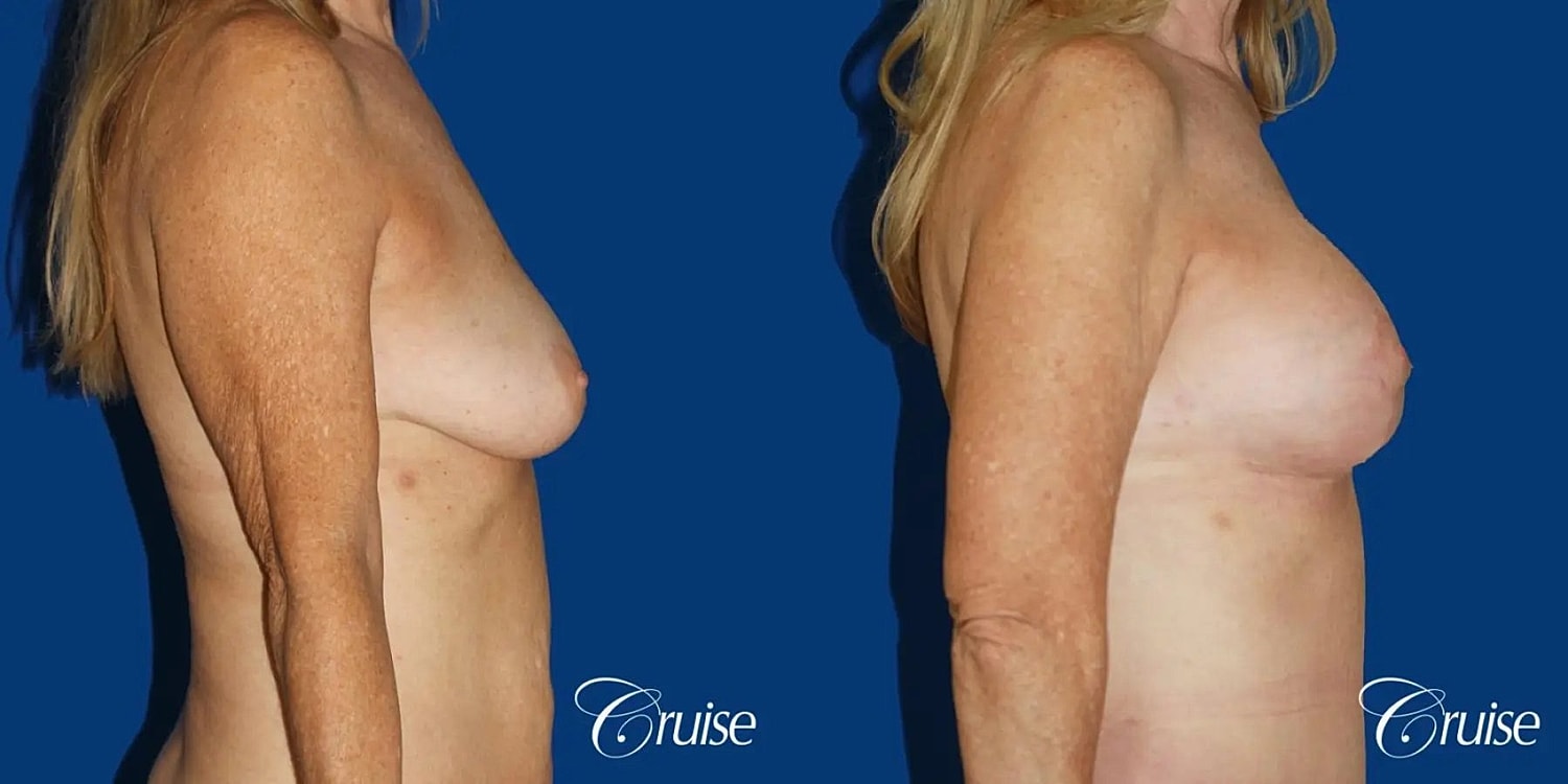 Breast Lift Augmentation Before & After