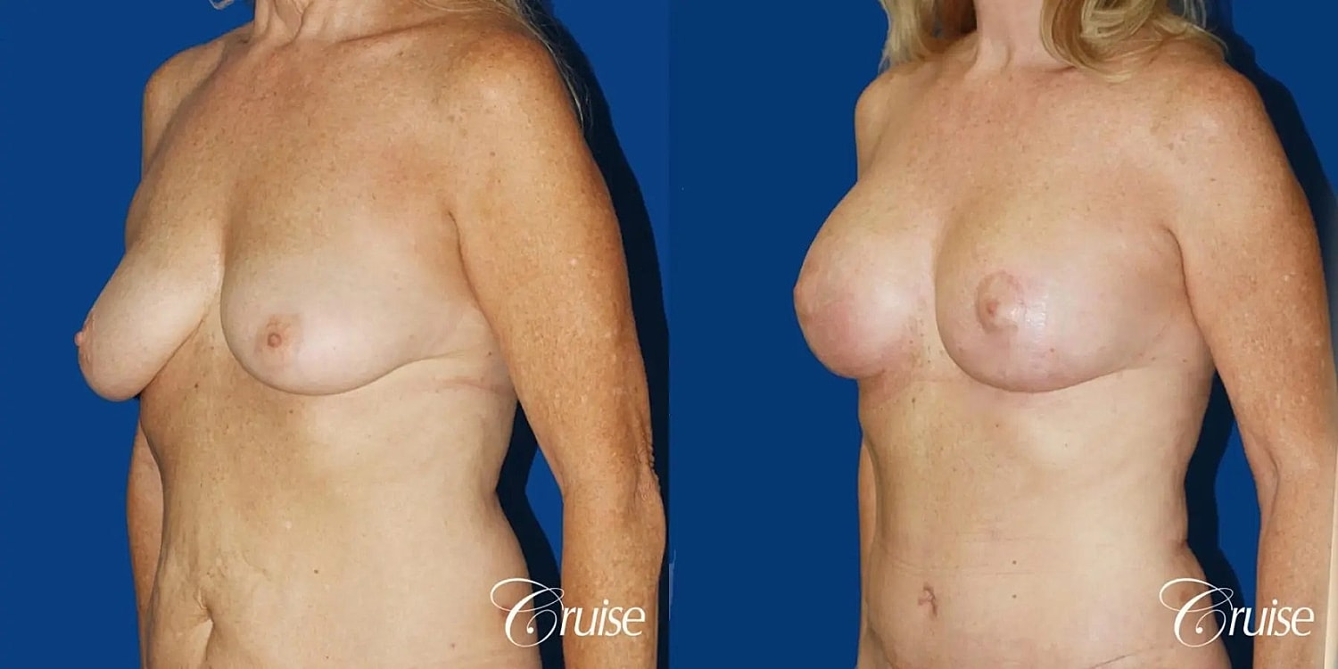 Breast Lift Augmentation Before & After