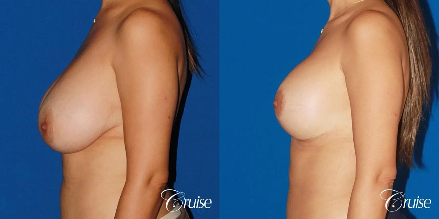 Breast Lift Augmentation Before & After