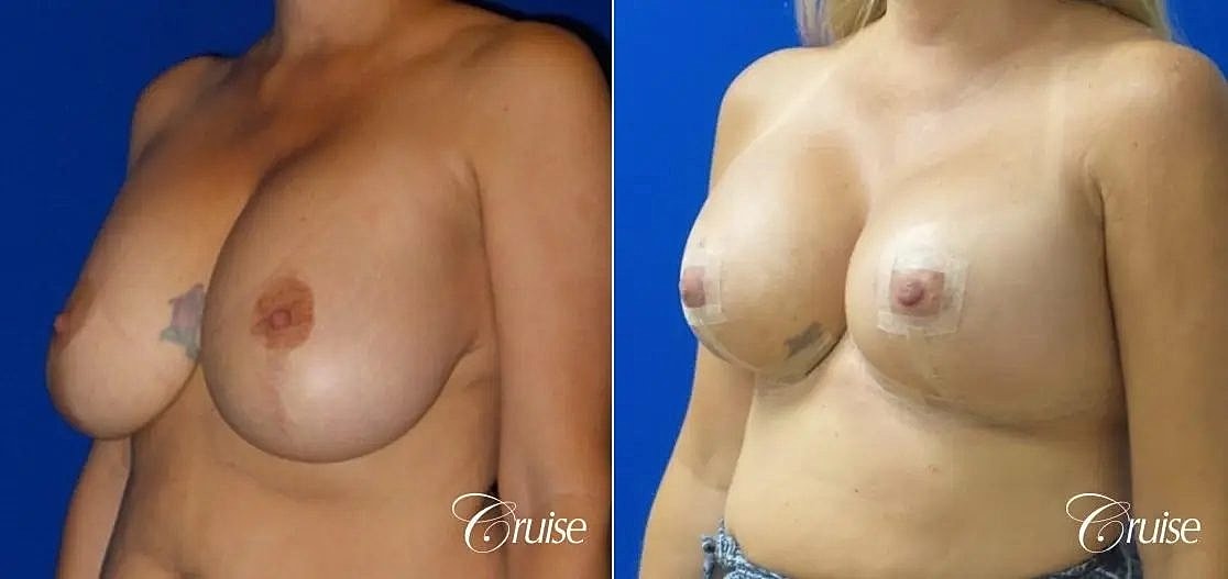 Breast Lift Augmentation Before & After