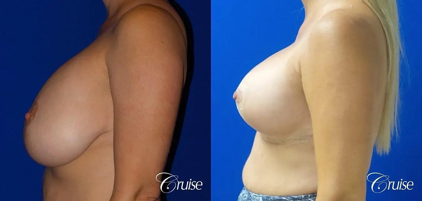 Breast Lift Augmentation Before & After