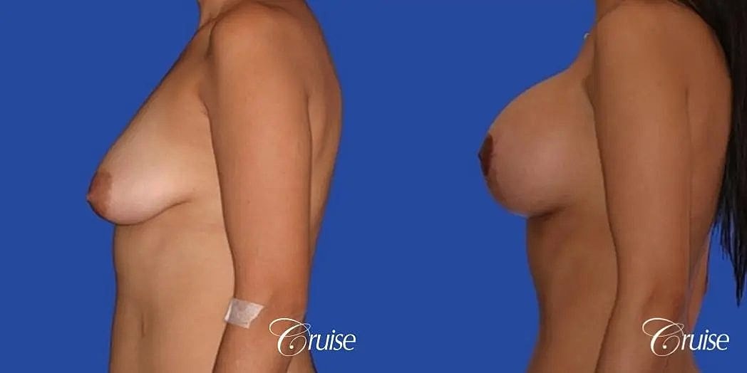 Breast Lift Augmentation Before & After