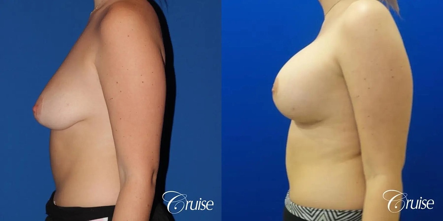 Breast Lift Augmentation Before & After