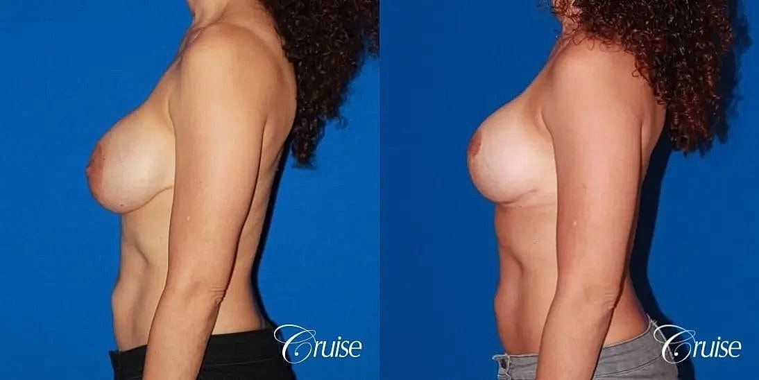 Breast Lift Augmentation Before & After