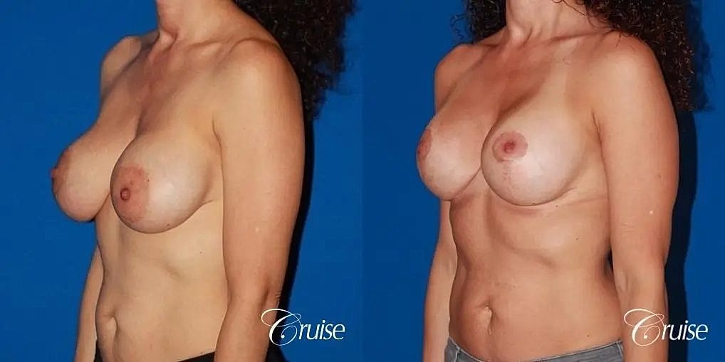 Breast Lift Augmentation Before & After