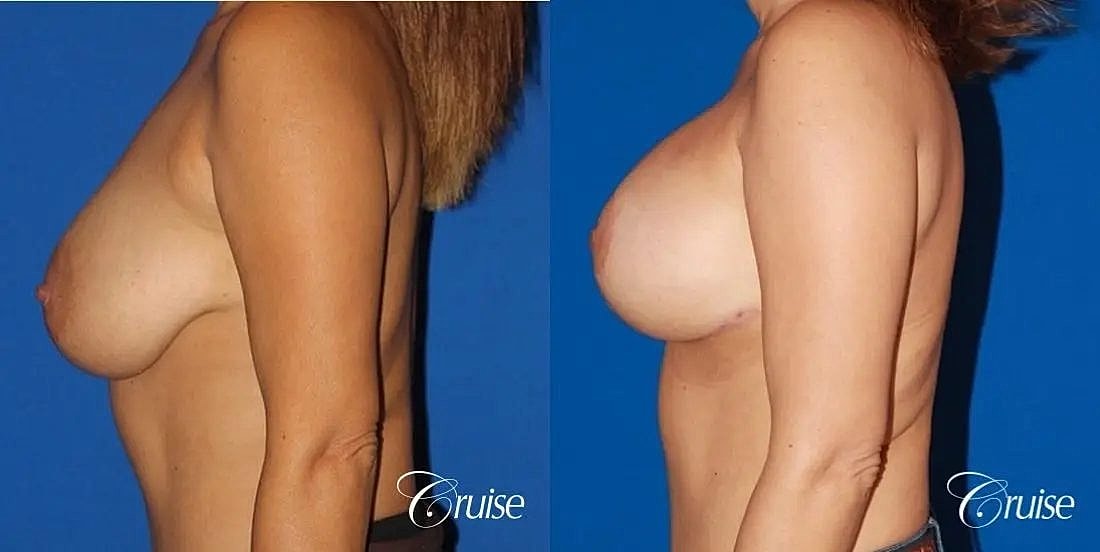 Breast Lift Augmentation Before & After