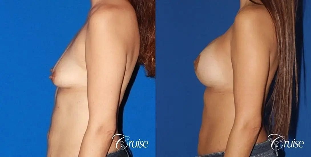 Breast Lift Augmentation Before & After