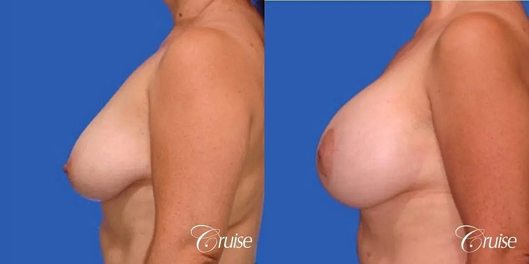 Breast Lift Augmentation Before & After