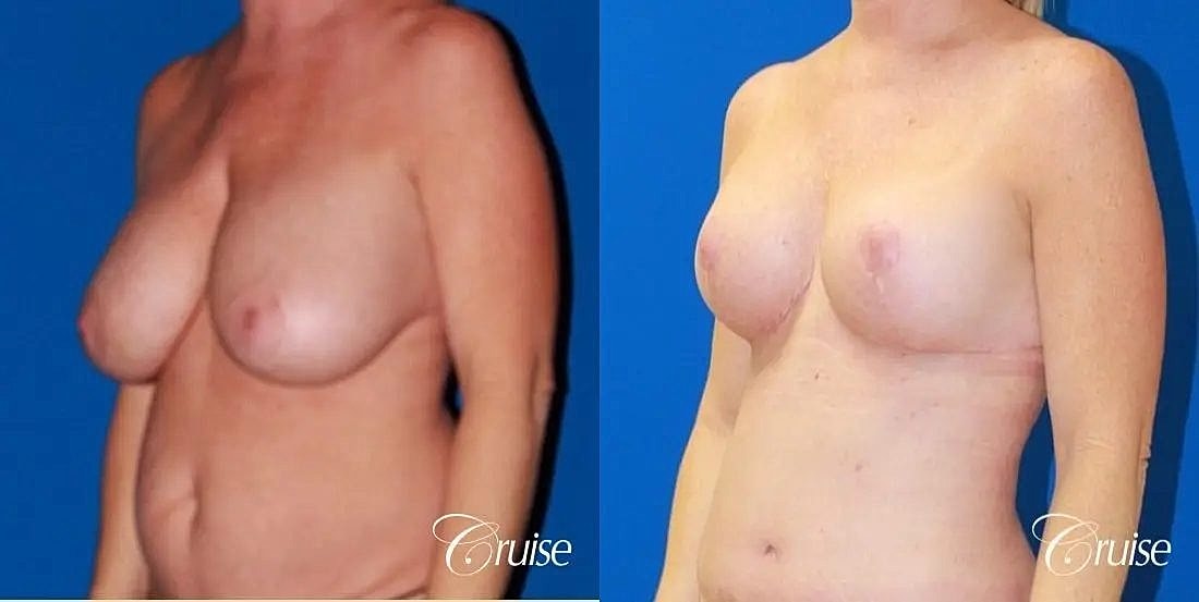 Breast Lift Augmentation Before & After