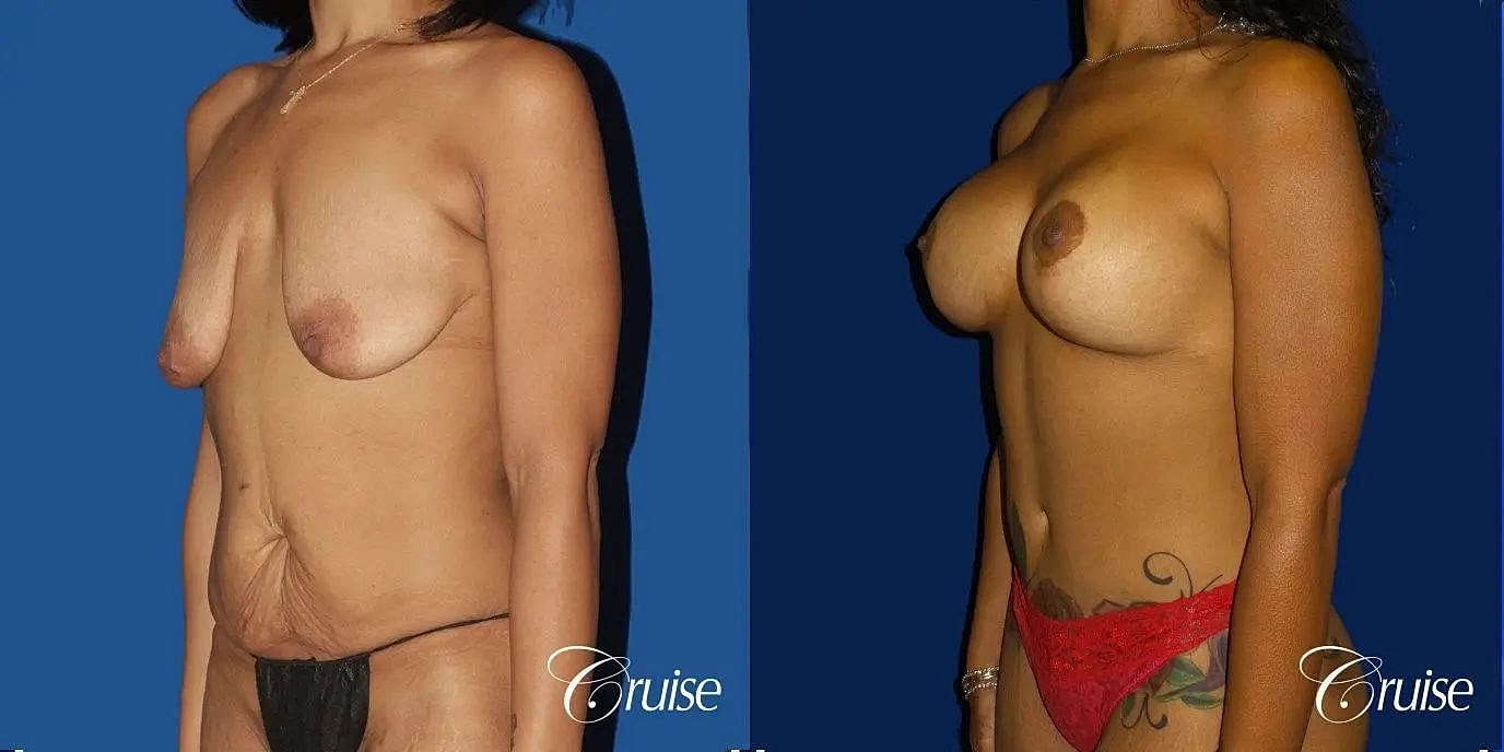 Breast Lift Augmentation Before & After