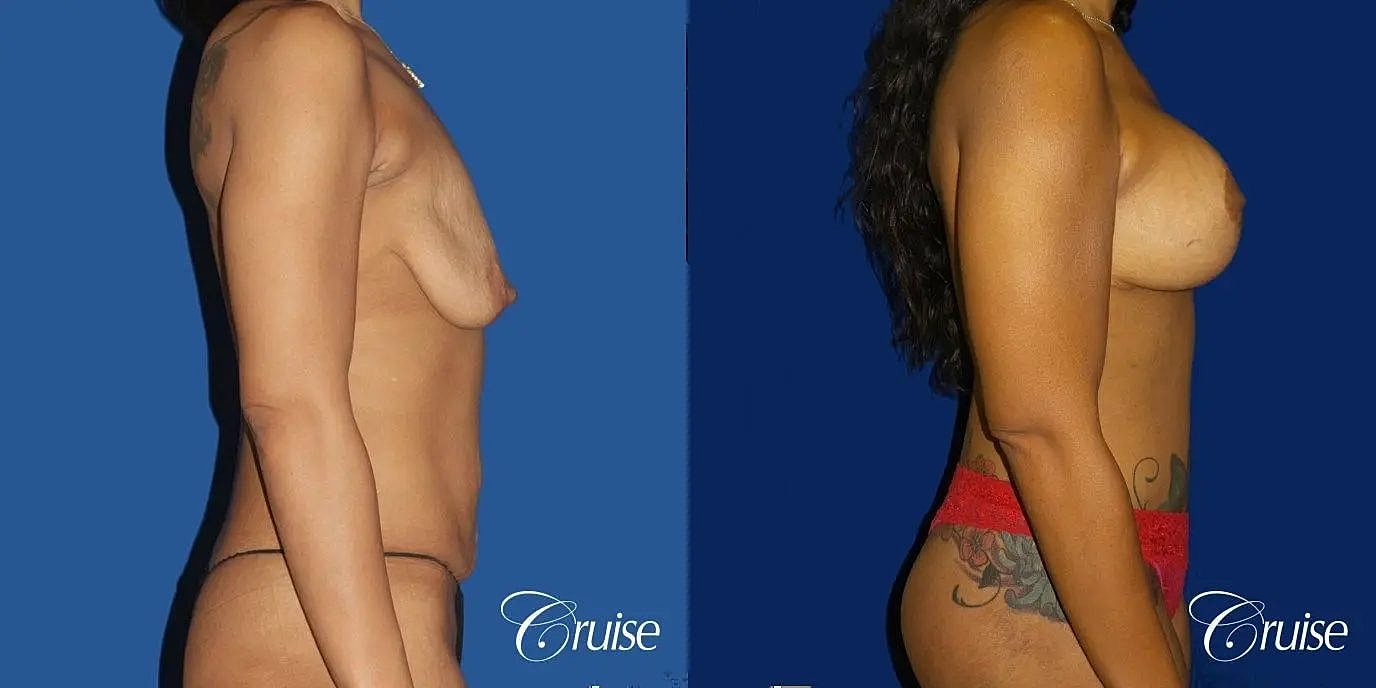Breast Lift Augmentation Before & After