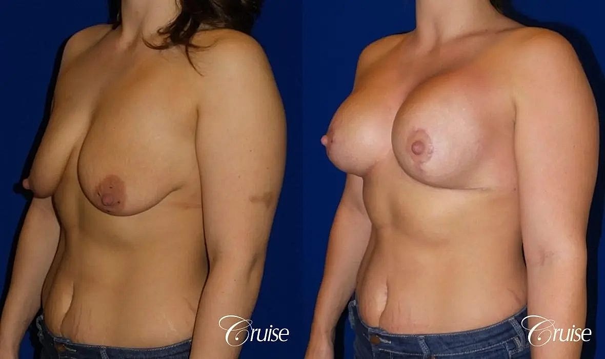 Breast Lift Augmentation Before & After