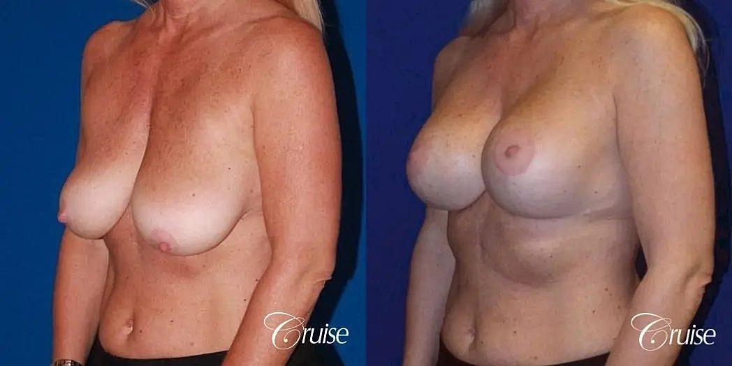 Breast Lift Augmentation Before & After