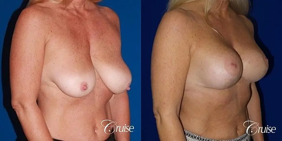 Breast Lift Augmentation Before & After