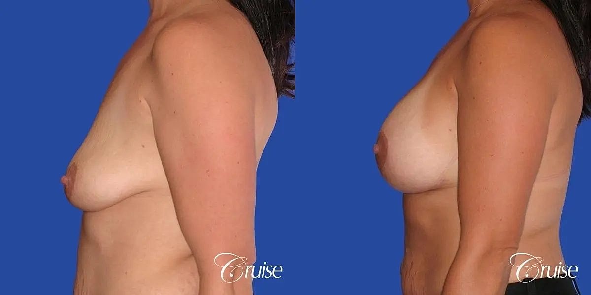 Breast Lift Augmentation Before & After