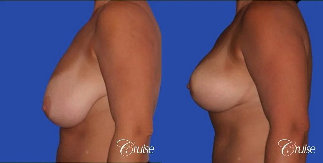 Breast Lift Augmentation Before & After