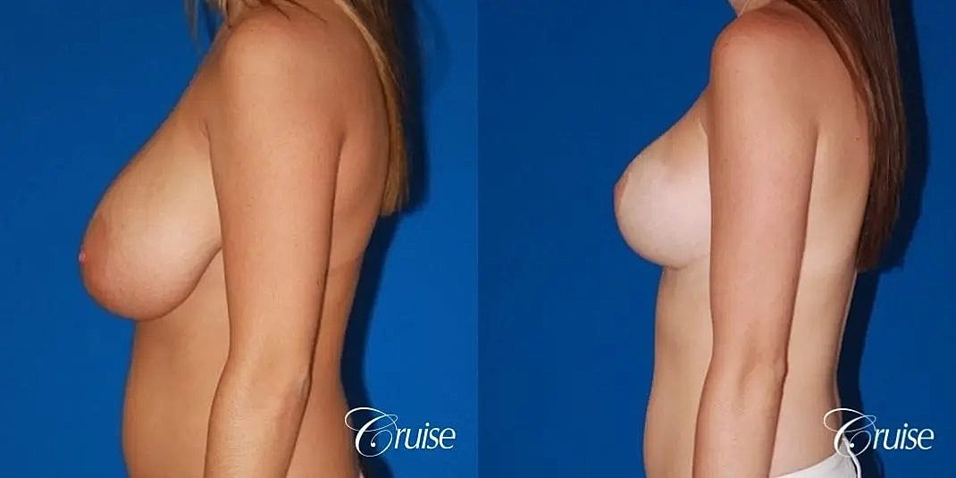 Breast Lift Augmentation Before & After
