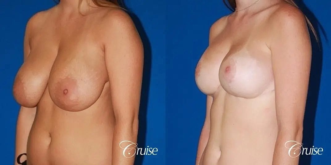 Breast Lift Augmentation Before & After