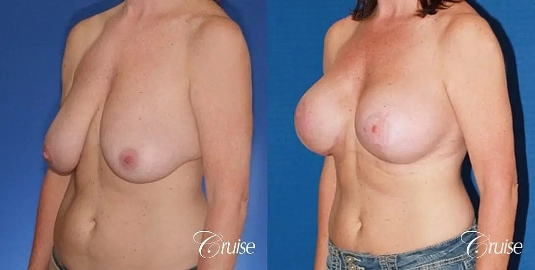 Breast Lift Augmentation Before & After