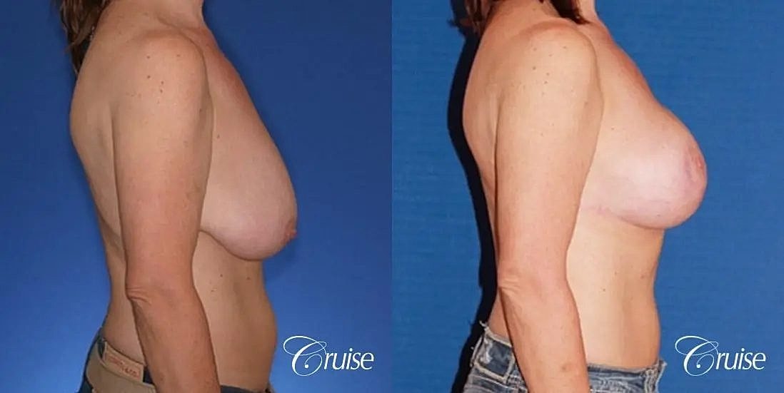 Breast Lift Augmentation Before & After