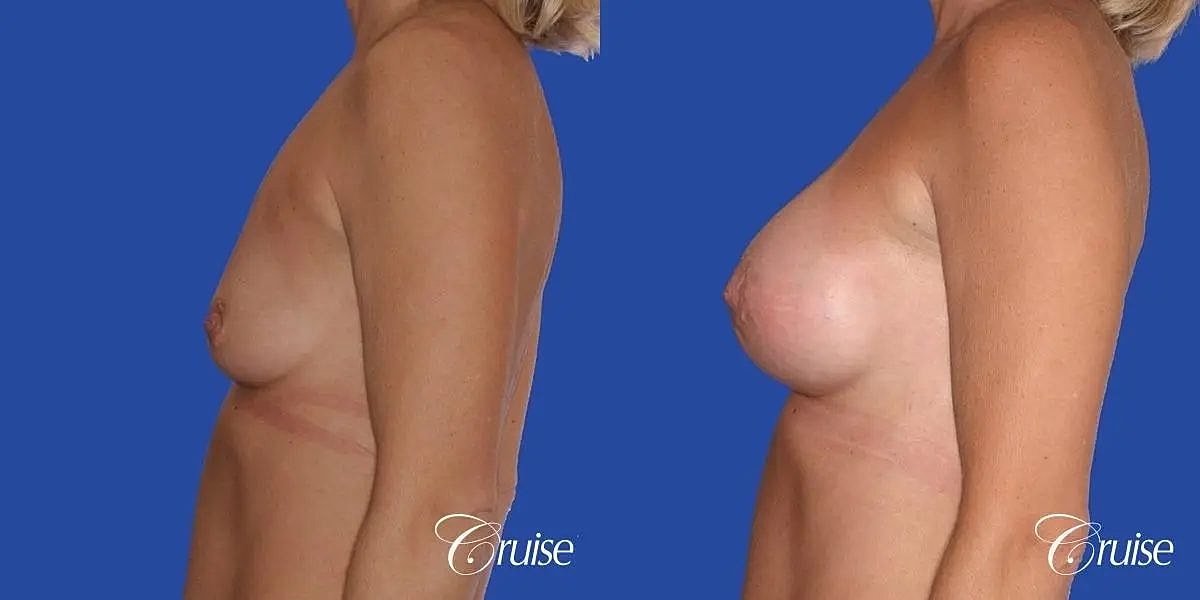 Breast Lift Augmentation Before & After