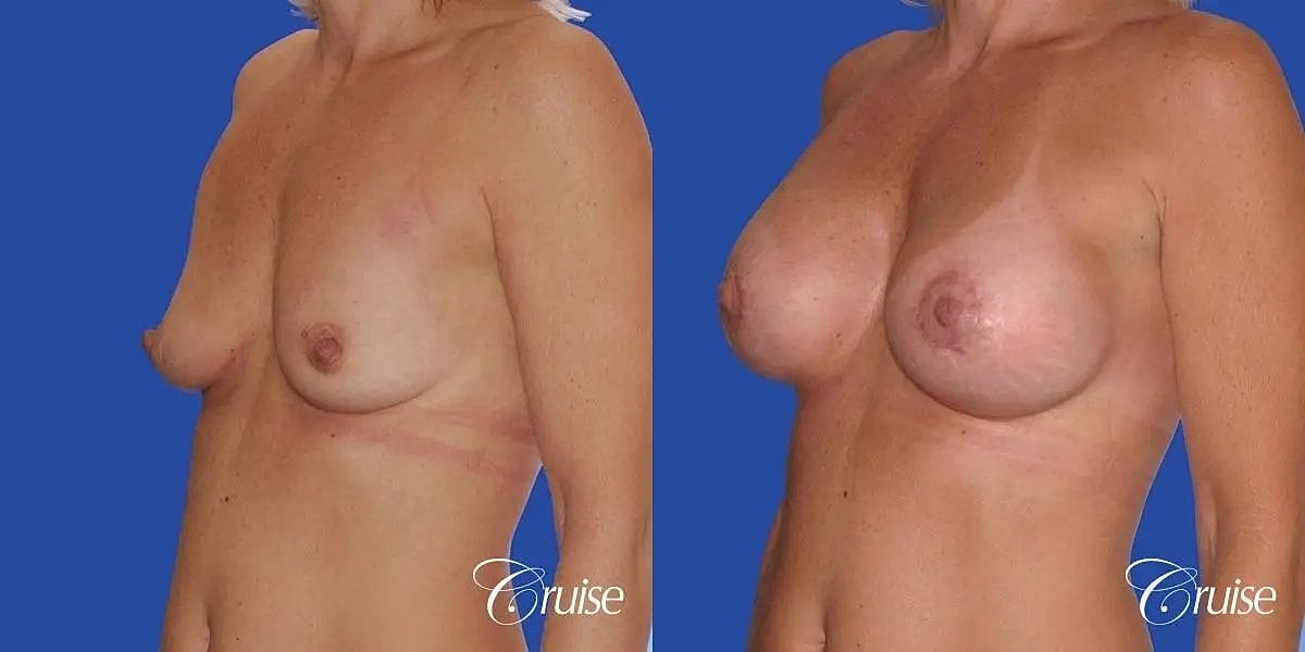 Breast Lift Augmentation Before & After