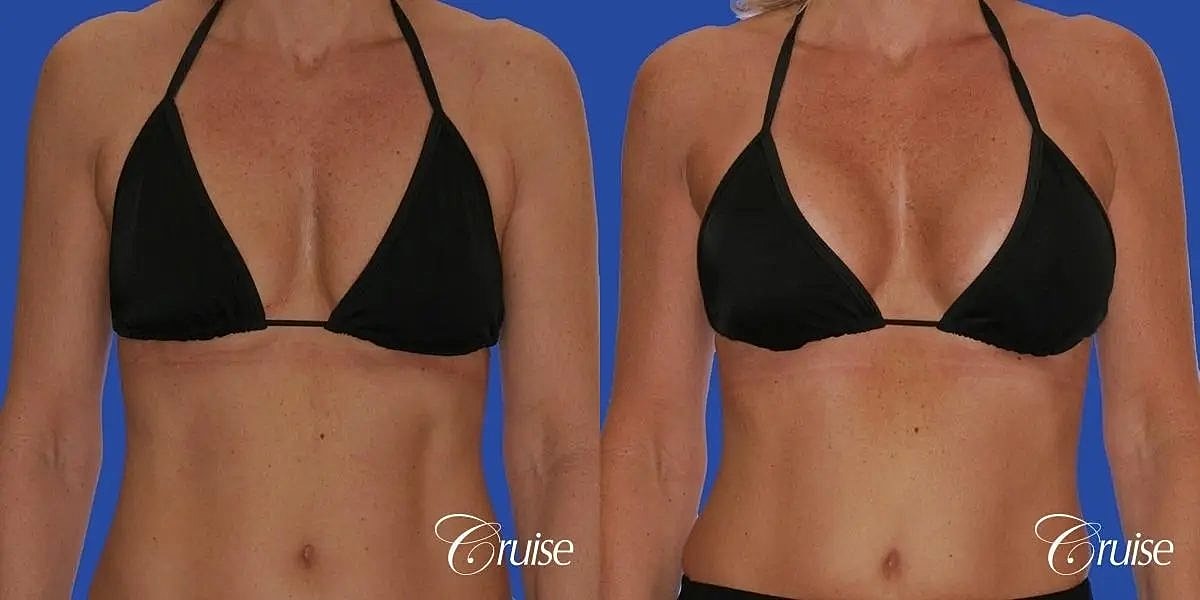 Breast Lift Augmentation Before & After