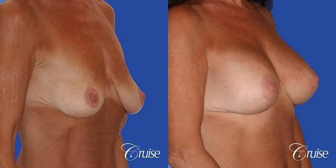 Breast Lift Augmentation Before & After