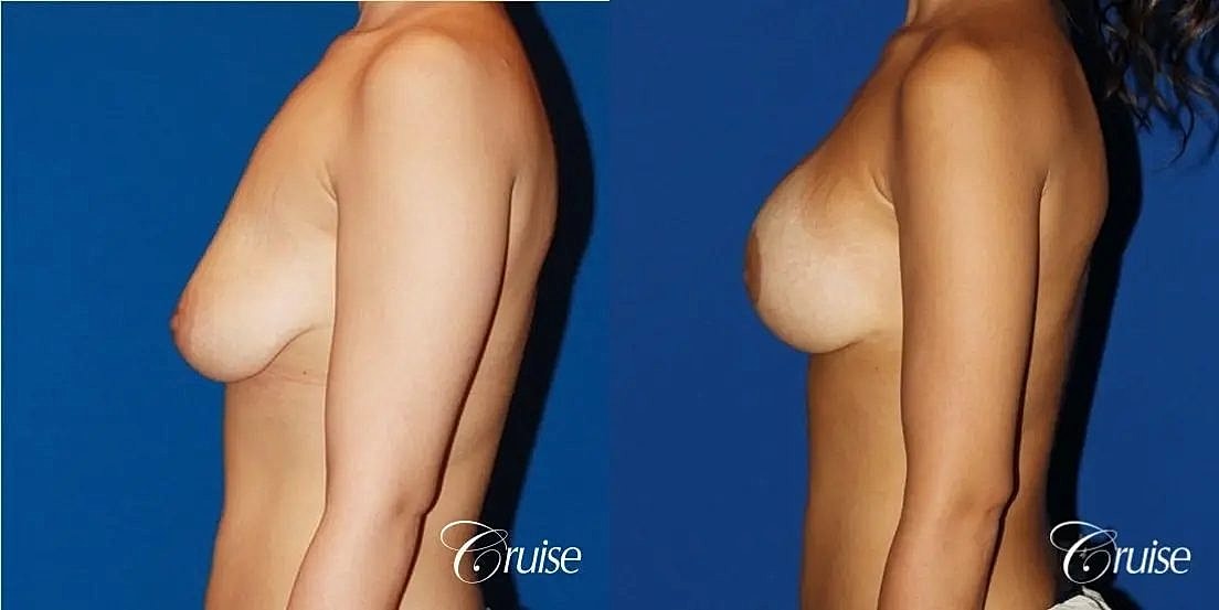 Breast Lift Augmentation Before & After