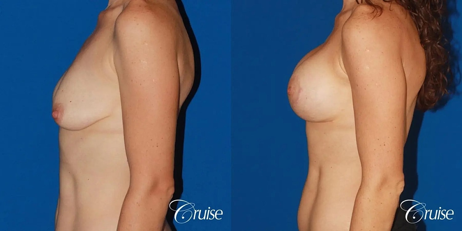 Breast Lift Augmentation Before & After