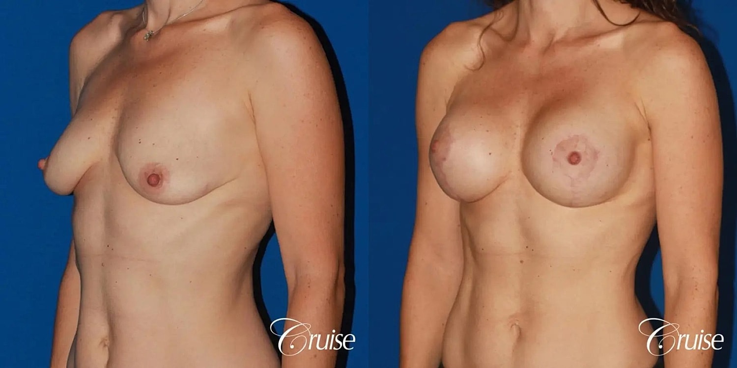 Breast Lift Augmentation Before & After