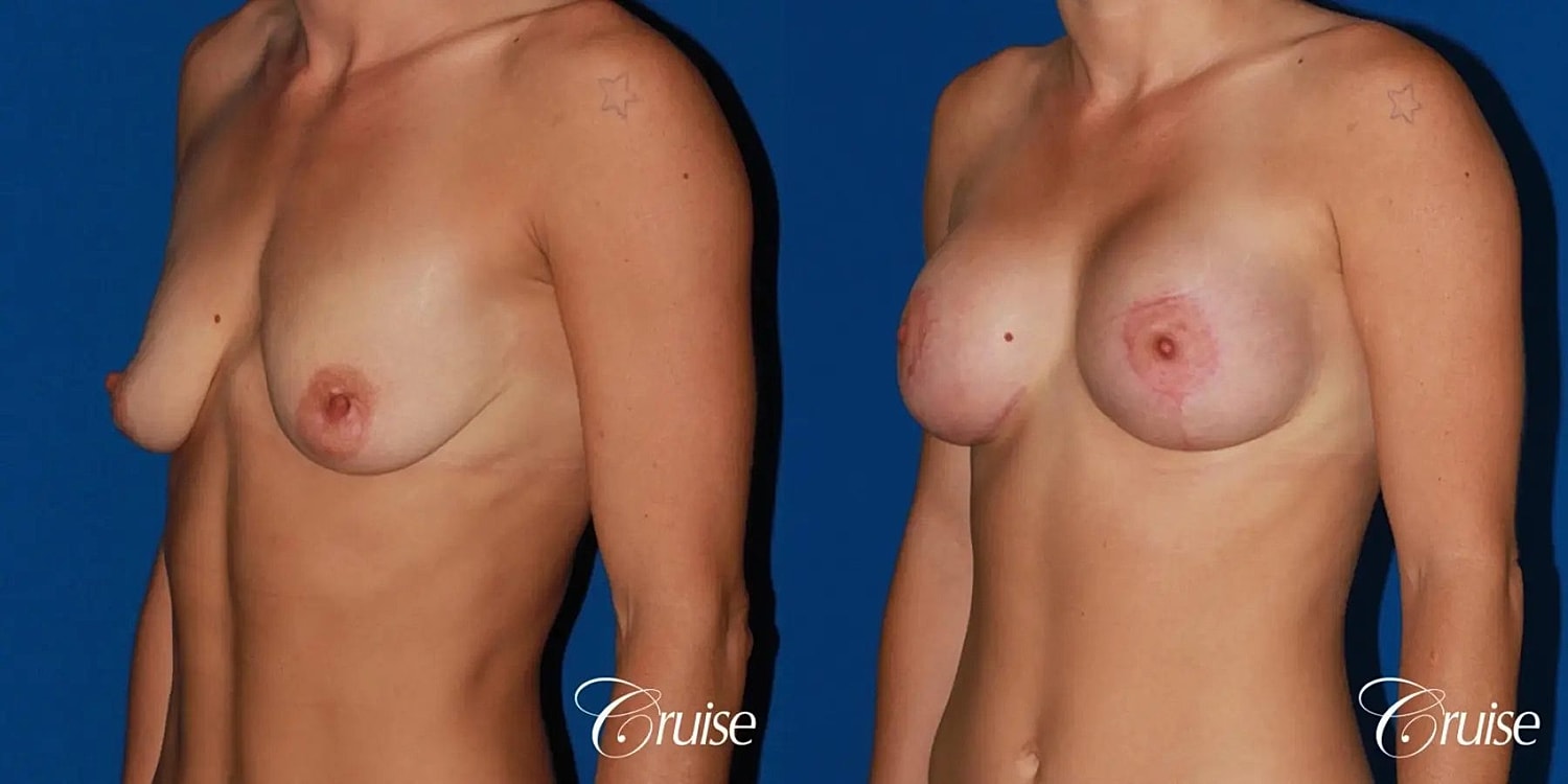 Breast Lift Augmentation Before & After