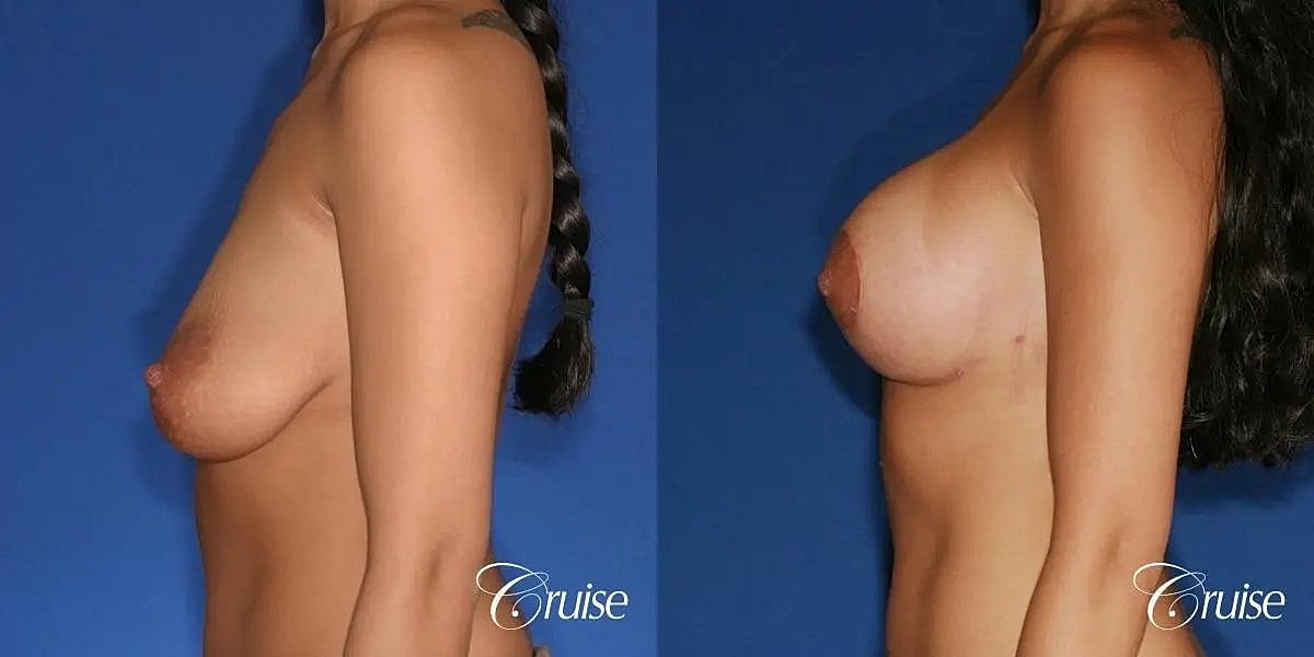 Breast Lift Augmentation Before & After
