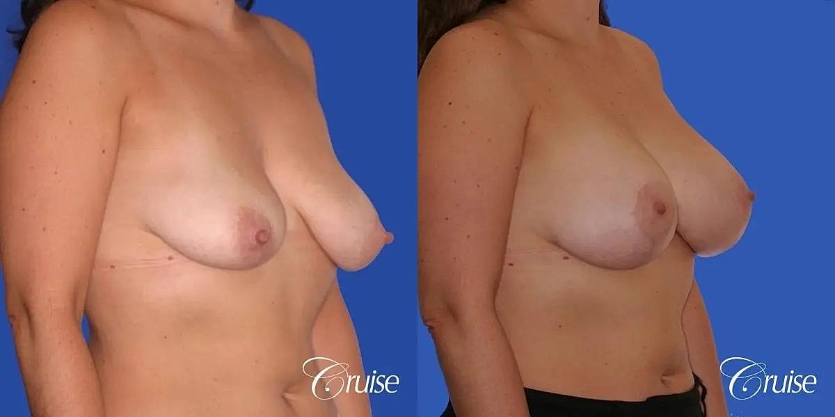 Breast Lift Augmentation Before & After