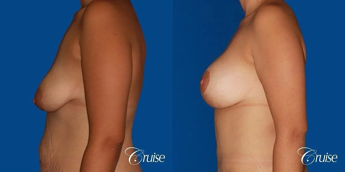 Breast Lift Augmentation Before & After