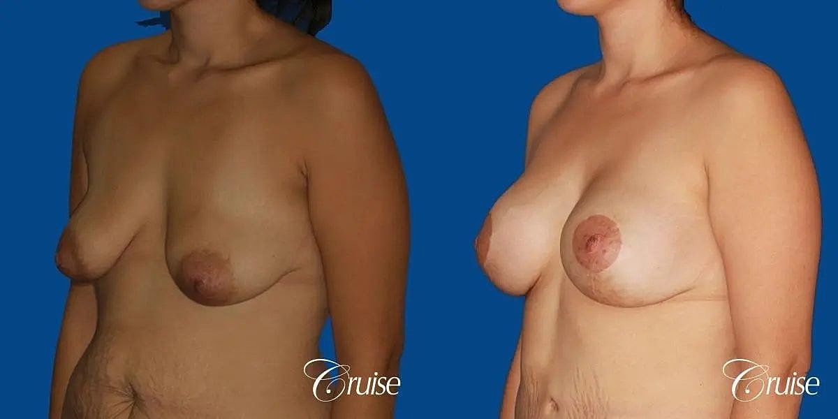 Breast Lift Augmentation Before & After