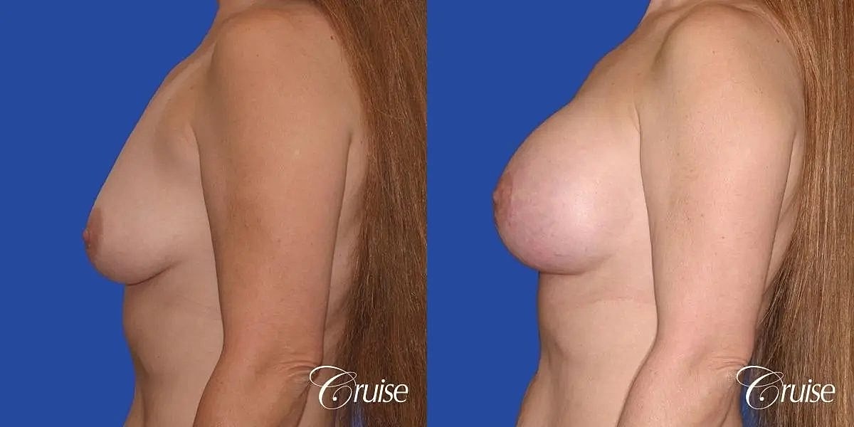 Breast Lift Augmentation Before & After