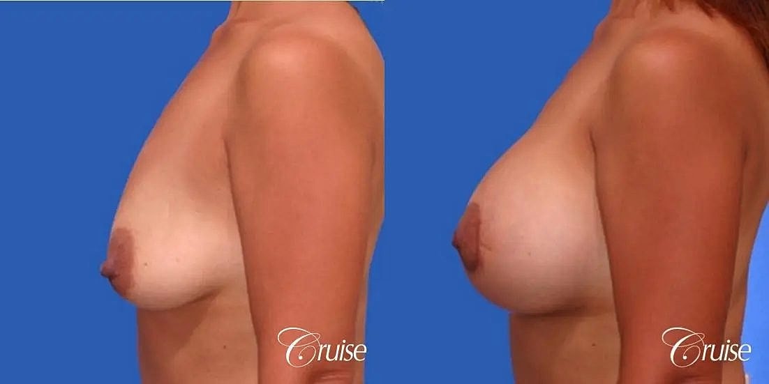 Breast Lift Augmentation Before & After