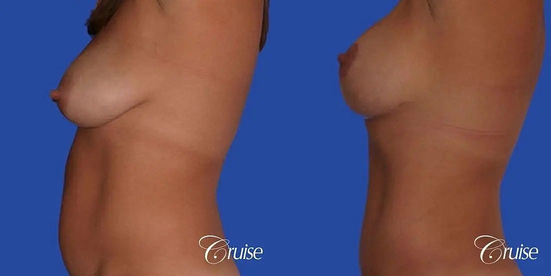 Breast Lift Augmentation Before & After