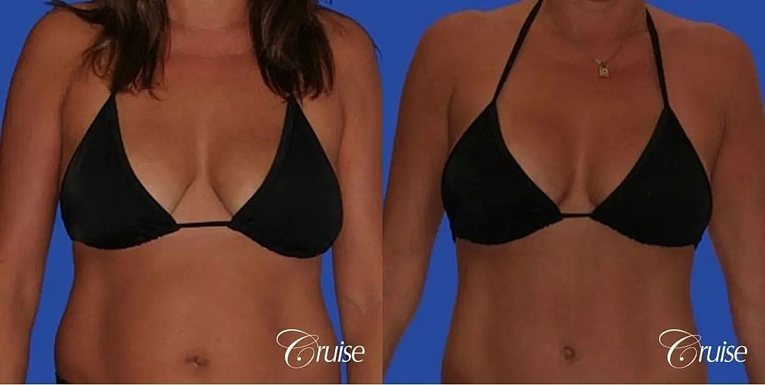 Breast Lift Augmentation Before & After