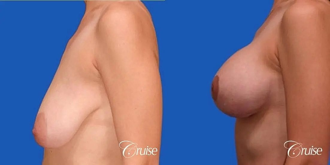 Breast Lift Augmentation Before & After