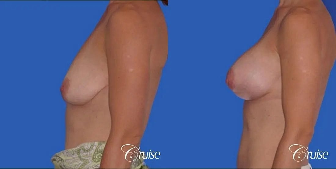 Breast Lift Augmentation Before & After