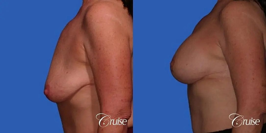 Breast Lift Augmentation Before & After